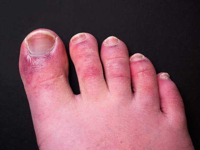 Bahaya Covid Toe, Penyakit Setelah Terpapar Covid-19