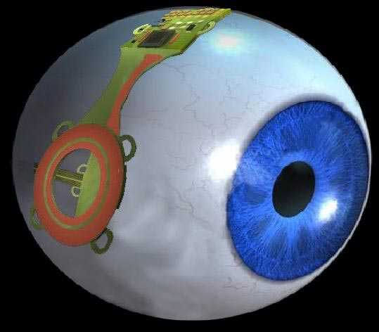 Bionic Eye,Teknologi Canggih Atasi Kebutaan