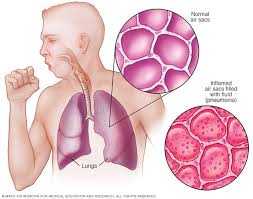 Cegah Pneumonia Jadi The Silent Killer Anak