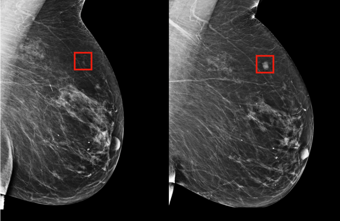 Comedocarcinoma dan Pentingnya Mamografi pada Kanker Payudara