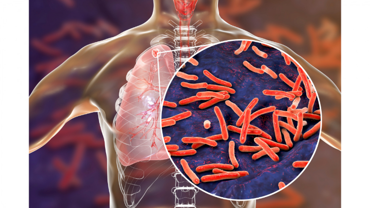 Dampak Negatif Pandemi Covid-19 Terhadap Penanganan Tuberkulosis di Dunia