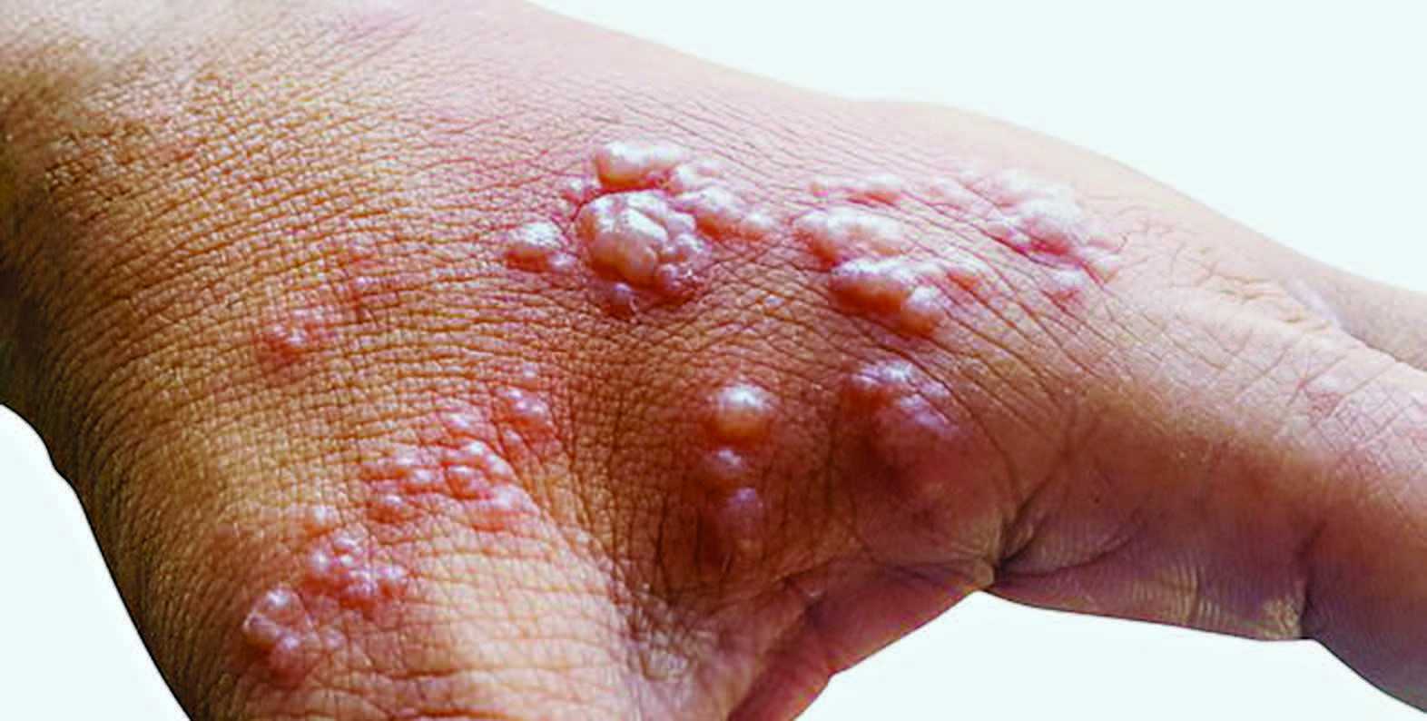 Efek Samping Vaksin Pfizer Timbulkan Herpes Zoster
