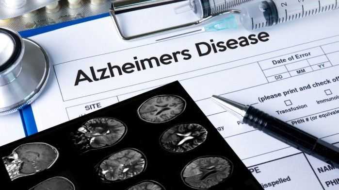 FDA Beri Persetujuan Penuh Obat Alzheimer Baru