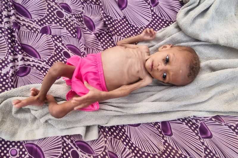 Gawat Mengagetkan, UNICEF Peringatkan 'Bencana' Malnutrisi Anak Akibat Peristiwa Mengerikan Ini