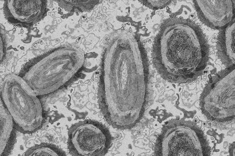 Gawat Semoga Tidak Menular ke Indonesia, Swedia Konfirmasi Kasus Pertama Varian Cacar Monyet di Luar Afrika