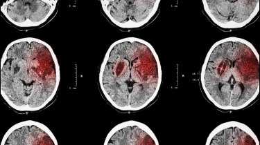 Ilmuwan Temukan Obat untuk Memperbaiki Kerusakan Otak Pasca Stroke