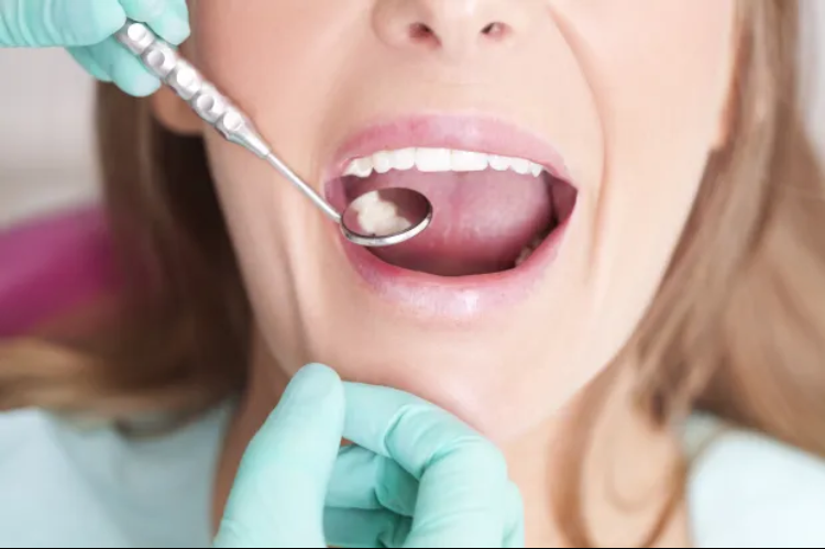 Infeksi di Sekitar Gigi Bisa Jadi Tanda Kanker Mulut