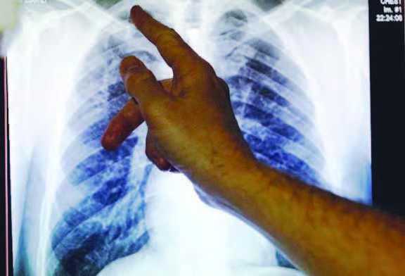Kasus TBC di Indonesia Masuk Peringkat Dua Global