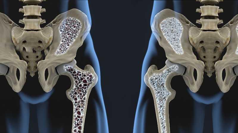 Kekurangan Susu Masa Kanak-kanak Picu Osteoporosis