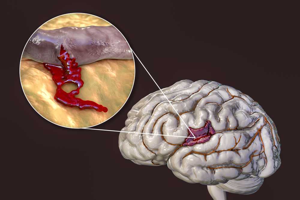 Mengenal Enam Gejala Umum Penyebab Pendarahan Otak
