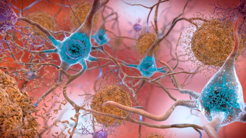 Mengenal Lecanemab, 'Senjata' Baru Melawan Alzheimer
