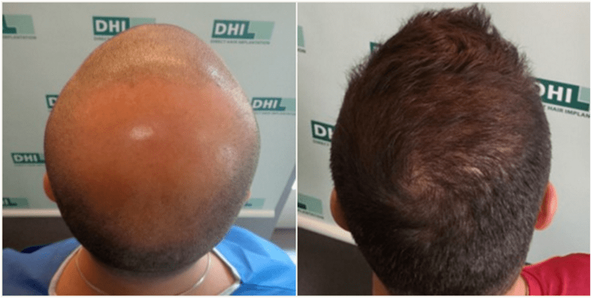 Metode DHI Efektif Atasi Kerusakan Garis Rambut