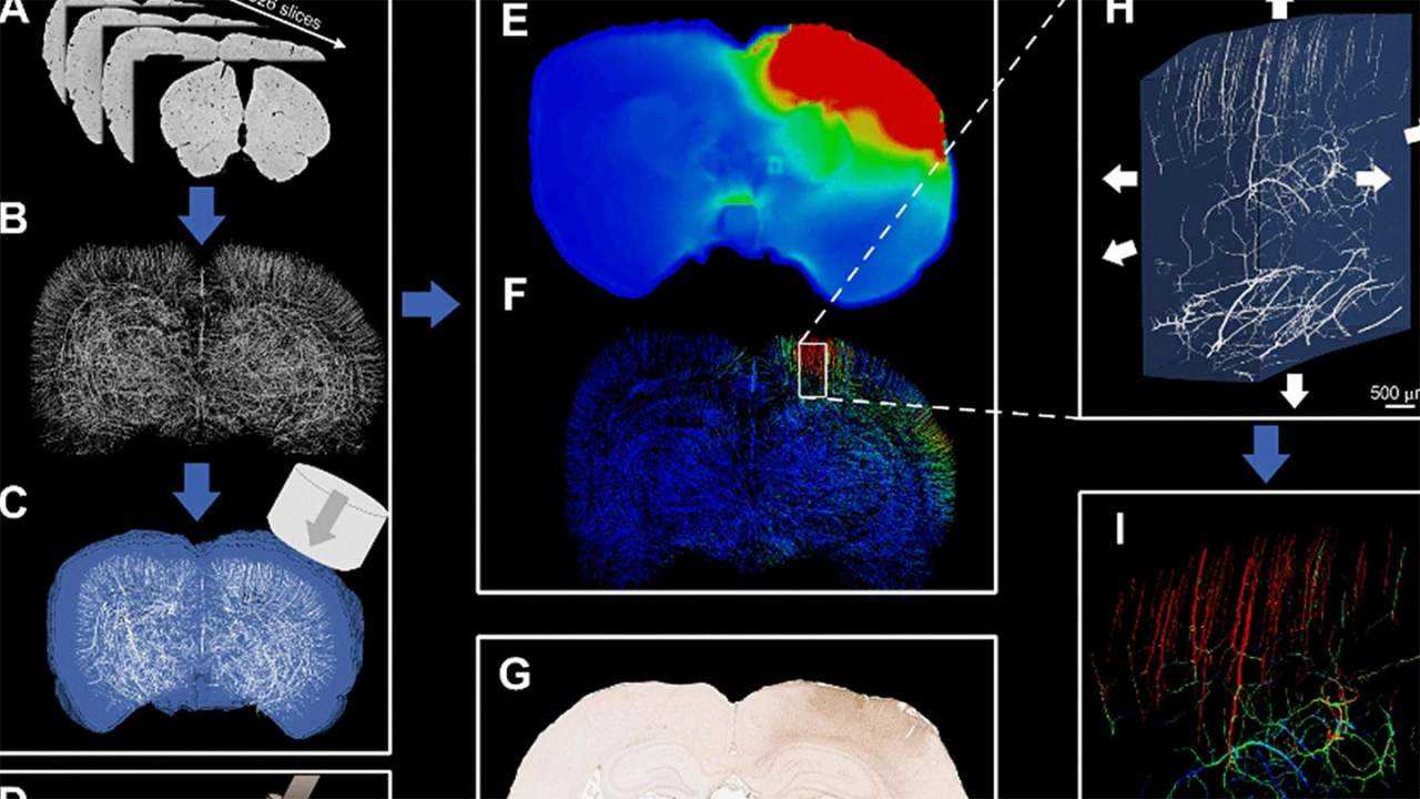 Model Komputer Terbaru Dapat Memetakan Pembuluh Darah Otak yang Terkena Traumatis