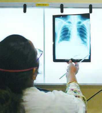 Obat Murah Dapat Kurangi Setengah Risiko TBC Resisten