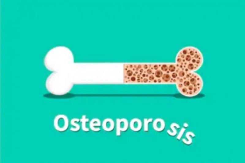 Osteoporosis Bisa Dicegah Sejak Usia Muda, Ini Caranya