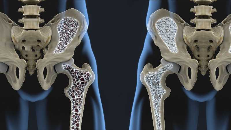 Osteoporosis Dapat Dimulai Pada Usia 30 Tahun