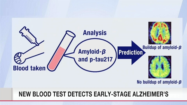 Peneliti Jepang Berhasil Deteksi Alzheimer Melalui Tes Darah