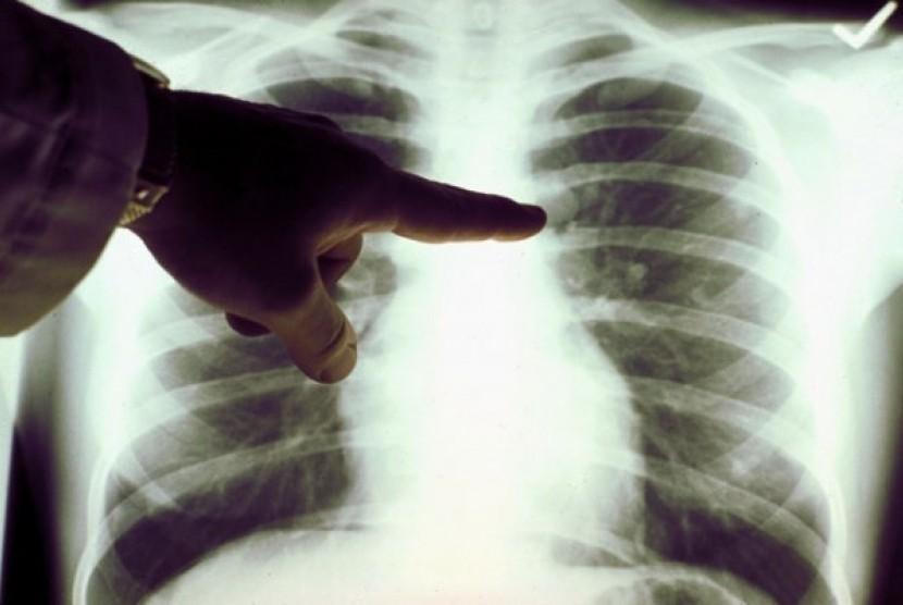 Karakter Sel Kanker Paru-paru yang Menyebar dalam Tubuh