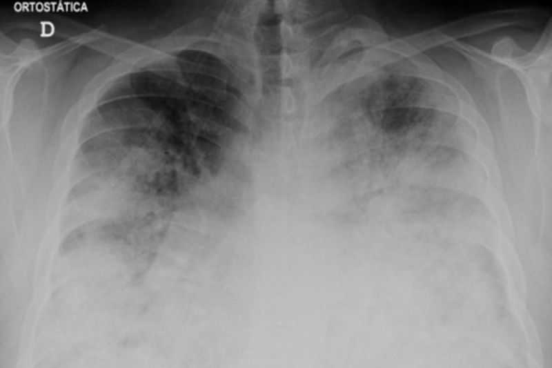 Radang Paru-paru, Kematian Akibat Penyakit Legionnaires di Polandia Jadi 16 Orang