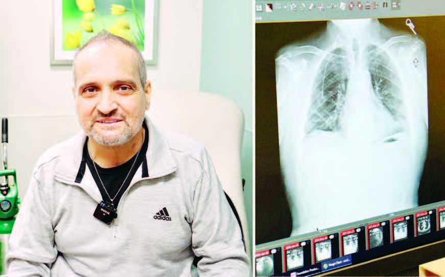 Transplantasi Paru-paru Ganda Selamatkan Pengidap Kanker Stadium Akhir