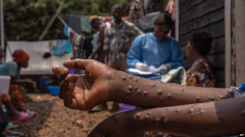 Zimbabwe Laporkan Dua Kasus Pertama Virus Mpox